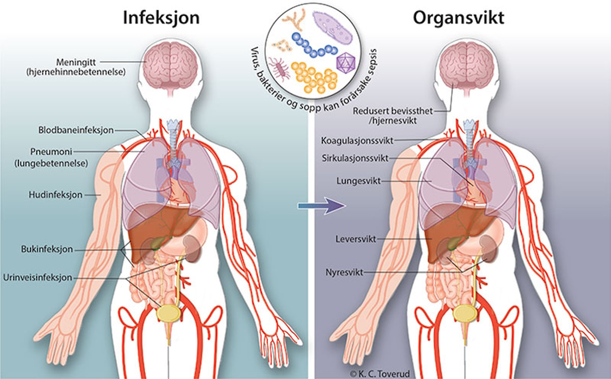 Sepsis: infeksjon - organsvikt