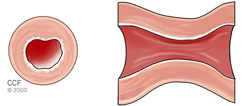 Illustrasjon av spasme-angina