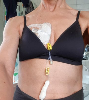 Siri Norderhus, før lungetransplantert, med veneport