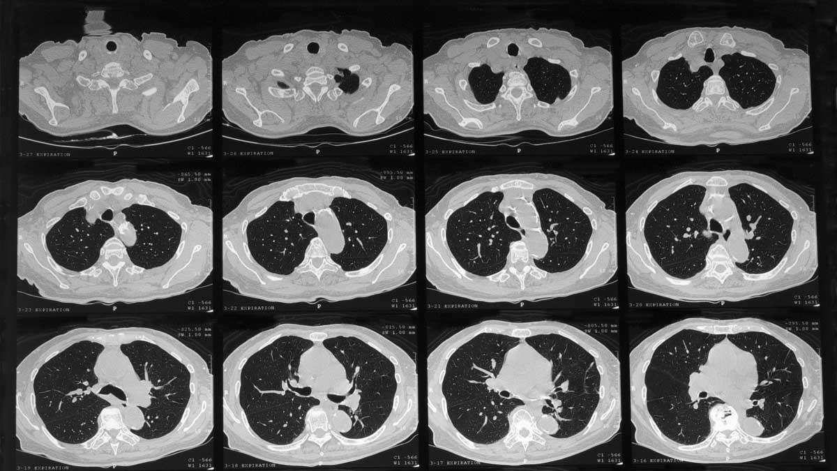 bilde av en HRCT-scanning tatt på datamaskinen hvor man ser små tverrsnitt av brystkassen til en pasient