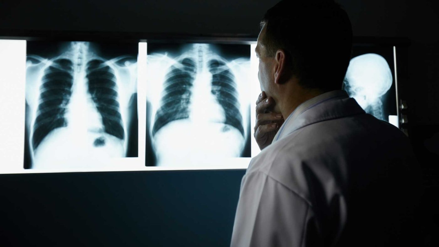 Illustrasjon av røntgen av lunger