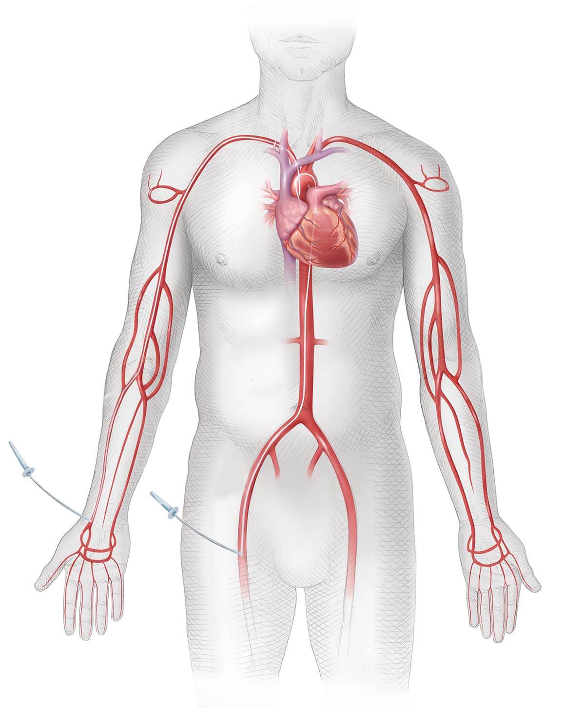 Illustrasjon av hjertekatetrisering