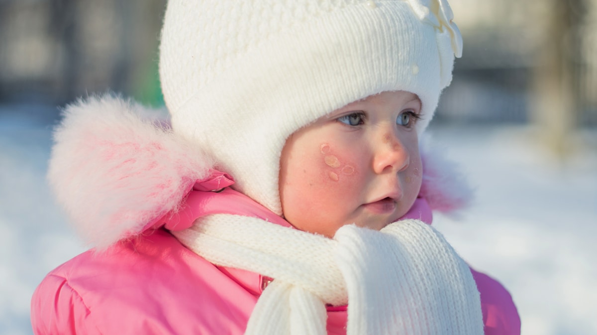 Lite barn med kuldeallergi